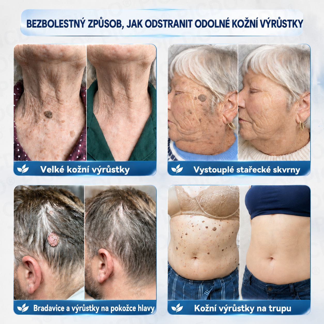 𝐏𝐢𝐜𝐝𝐨® 🍀𝟕𝐝𝐞𝐧𝐧í 𝐊𝐫é𝐦 𝐍𝐚 𝐎𝐝𝐬𝐭𝐫𝐚𝐧ě𝐧í 𝐊𝐨ž𝐧í𝐜𝐡 𝐕ý𝐫ů𝐬𝐭𝐤ů 𝐀 𝐒𝐤𝐯𝐫𝐧 🩵 (Bezbolestné složení, které nezanechává jizvy) 💪