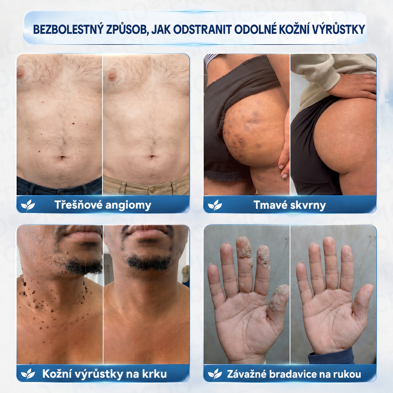 𝐏𝐢𝐜𝐝𝐨® 🍀𝟕𝐝𝐞𝐧𝐧í 𝐊𝐫é𝐦 𝐍𝐚 𝐎𝐝𝐬𝐭𝐫𝐚𝐧ě𝐧í 𝐊𝐨ž𝐧í𝐜𝐡 𝐕ý𝐫ů𝐬𝐭𝐤ů 𝐀 𝐒𝐤𝐯𝐫𝐧 🩵 (Bezbolestné složení, které nezanechává jizvy) 💪