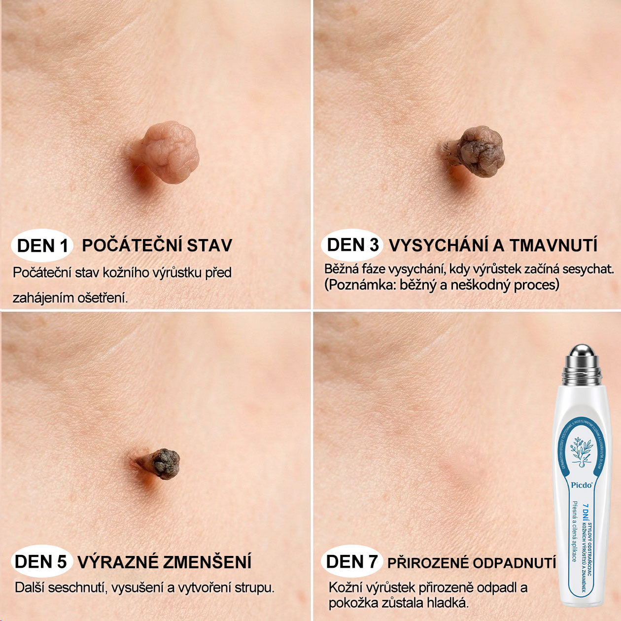 Oficiální značkový obchod🌱🌱|🖊️𝐏𝐢𝐜𝑑𝑜® 𝟩𝖽𝖾𝗻𝗻í 𝘰𝘥𝘴𝘵𝗋𝖺ň𝗈𝗏𝖺č 𝒔𝒌𝒗𝒓𝙣 𝙖 𝙥𝙞𝙜𝙢𝙚𝙣𝙩𝘰𝘷ý𝘤𝘩 𝘴𝘬𝖛𝖗𝖓 (Bezbolestný rollerball bez jizev)