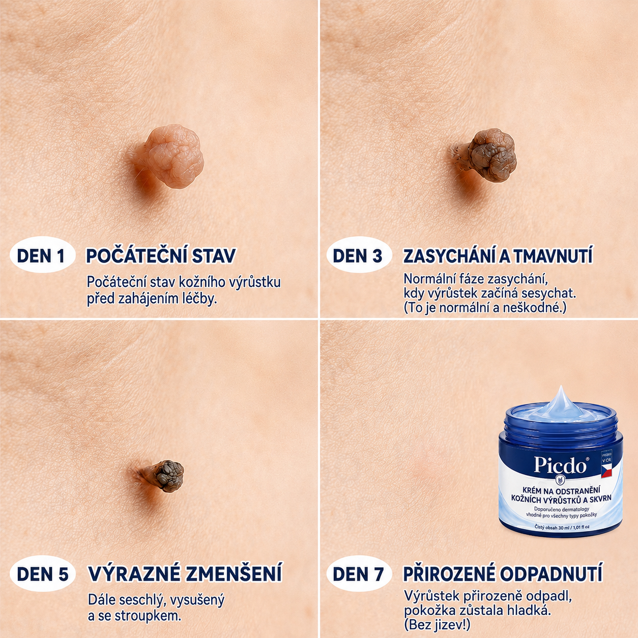 𝐏𝐢𝐜𝐝𝐨® 🍀𝟕𝐝𝐞𝐧𝐧í 𝐊𝐫é𝐦 𝐍𝐚 𝐎𝐝𝐬𝐭𝐫𝐚𝐧ě𝐧í 𝐊𝐨ž𝐧í𝐜𝐡 𝐕ý𝐫ů𝐬𝐭𝐤ů 𝐀 𝐒𝐤𝐯𝐫𝐧 🩵 (Bezbolestné složení, které nezanechává jizvy) 💪
